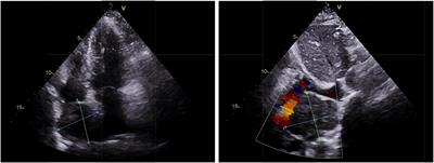 Multimodality Imaging Evaluation of Primary Right Atrial Paraganglioma: A Case Report and Literature Review